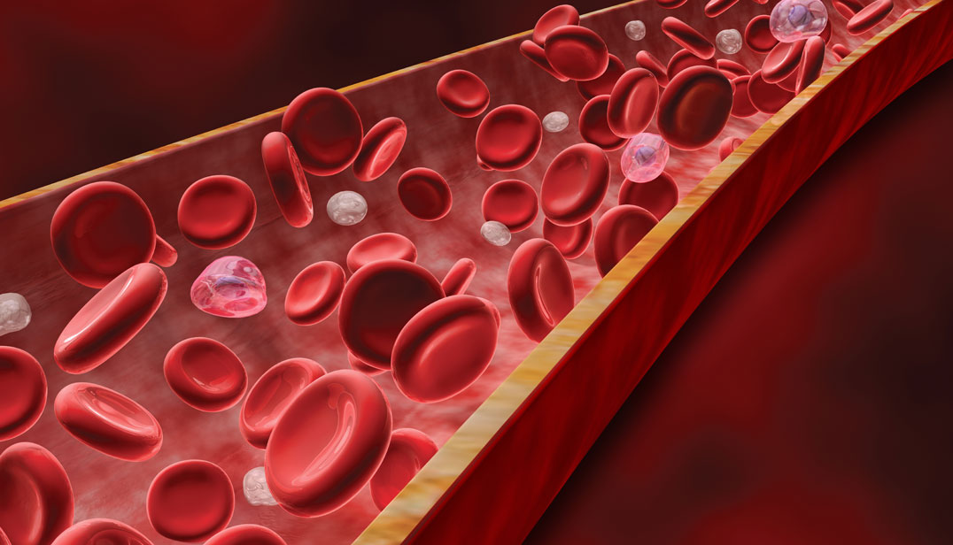 Evidências demonstram que cerca de 50% dos doentes com insuficiência cardíaca grave têm anemia Evidências demonstram que cerca de 50% dos doentes com insuficiência cardíaca grave têm anemia